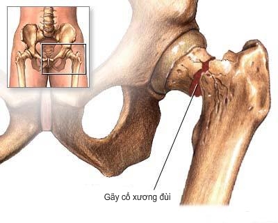 Gãy cổ xương đùi là biến chứng nghiêm trọng của loãng xương.