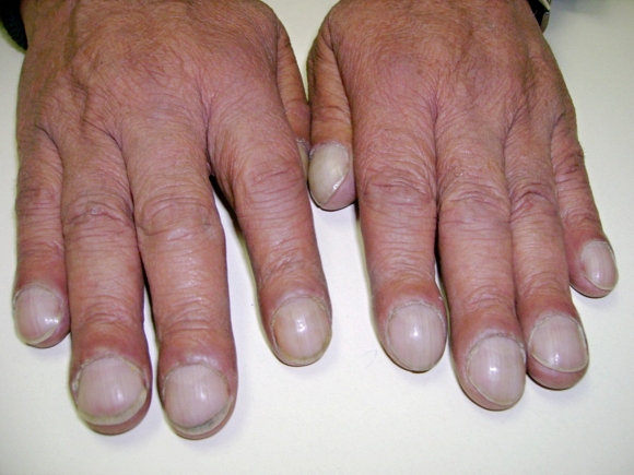 3 dấu hiệu trên móng tay tiết lộ bệnh tuyệt đối đừng bỏ qua
