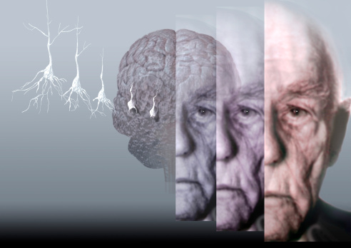 Alzheimer là bệnh thoái hóa cả não bộ không có khả năng hồi phục, gây nên chứng mất trí và sa sút trí tuệ - Ảnh: Internet