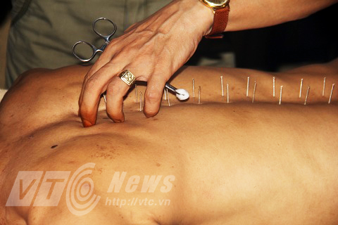 Hỏa châm có những lợi thế riêng biệt của nó