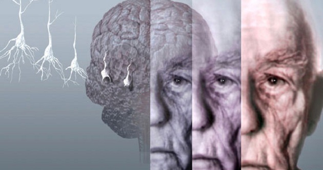Alzheimer là bệnh rối loạn não bộ tăng triển gây suy giảm trí nhớ, làm giảm khả năng thực hiện đối thoại, giao tiếp