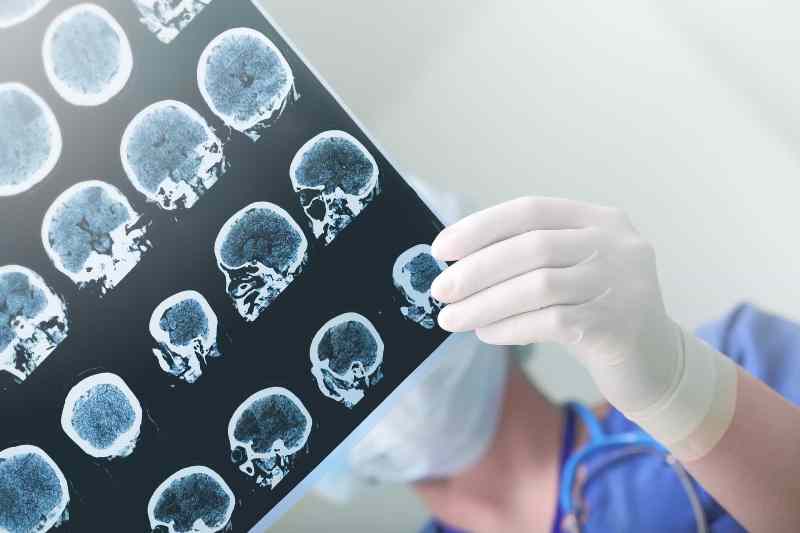 Bệnh Alzheimer là bất ổn não bộ diễn tiến từ từ