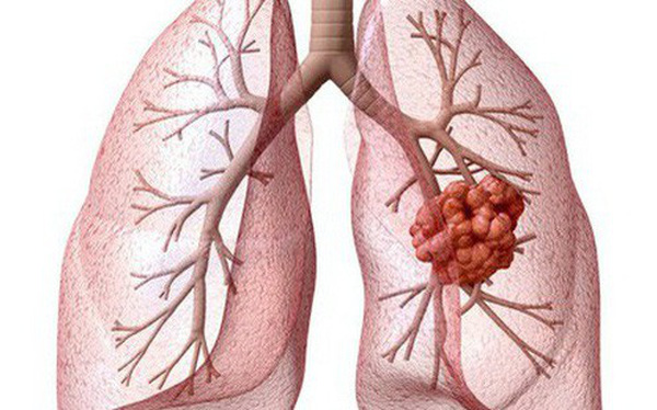 Ung thư phổi gây tử vong số 1: Những dấu hiệu cảnh báo sớm tuyệt đối không nên lờ đi