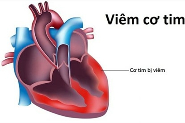 Viêm cơ tim gây nhiều biến chứng nặng.