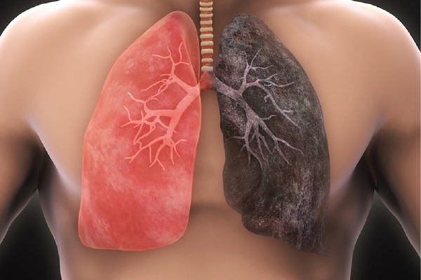 Ung thư phổi là ung thư phổ biến hàng đầu thế giới