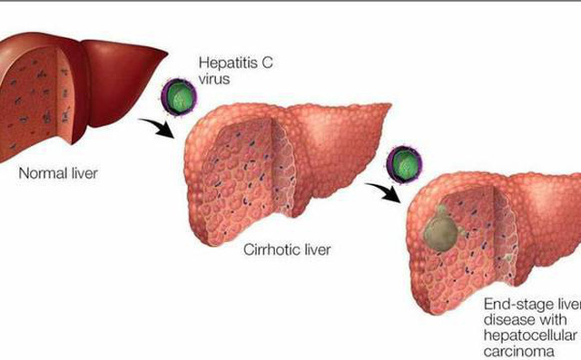 Virus viêm gan C - 'sát thủ thầm lặng' gây ung thư gan