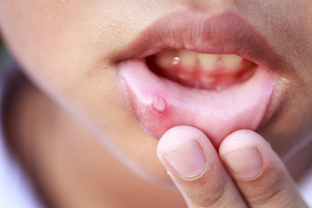 8 dấu hiệu phát hiện sớm ung thư khoang miệng