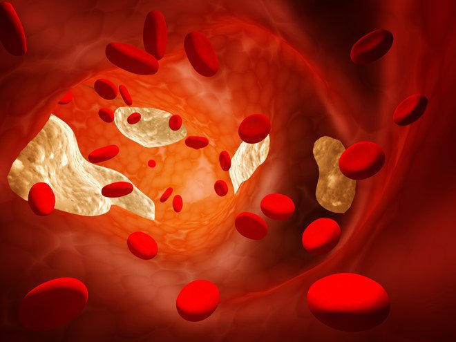 3 yếu tố gây ra cholesterol cao trong cơ thể