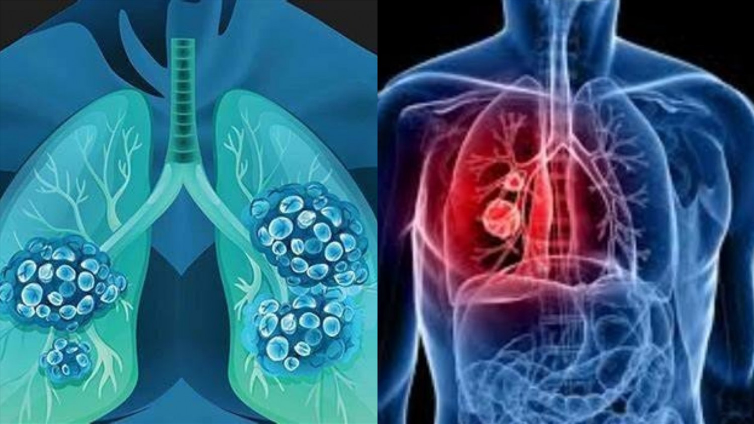 5 triệu chứng ung thư phổi cần nhận biết để điều trị kịp thời