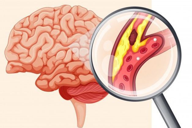 2 thói quen xấu có thể gây nhồi máu não ở người trung niên