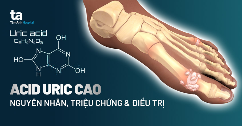 3 bất thường trên cơ thể báo hiệu axit uric tăng cao