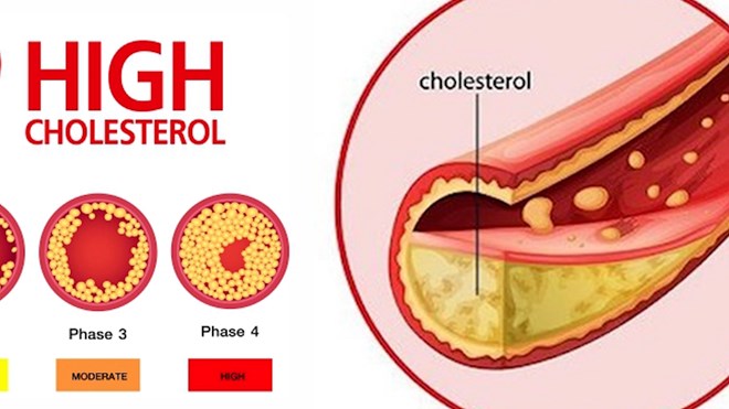 Tăng cholesterol khiến cơ thể mệt mỏi. Ảnh: Nguyễn Ly