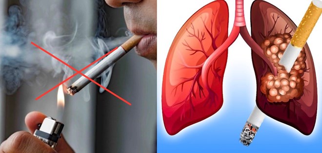 Cứ 10 trường hợp tử vong do ung thư phổi thì có 9 người hút thuốc lá